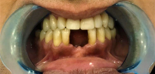 პაციენტი უჩიოდა ფრონტალური კბილების მეორად ადენტიას (კბილების დაკარგავს)