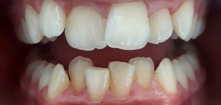The patient complained of a malocclusion