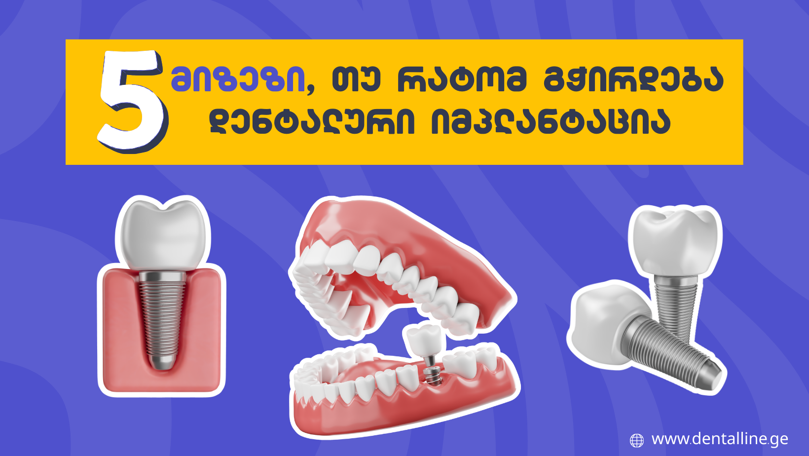 5 მიზეზი, თუ რატომ გჭირდება დენტალური იმპლანტაცია