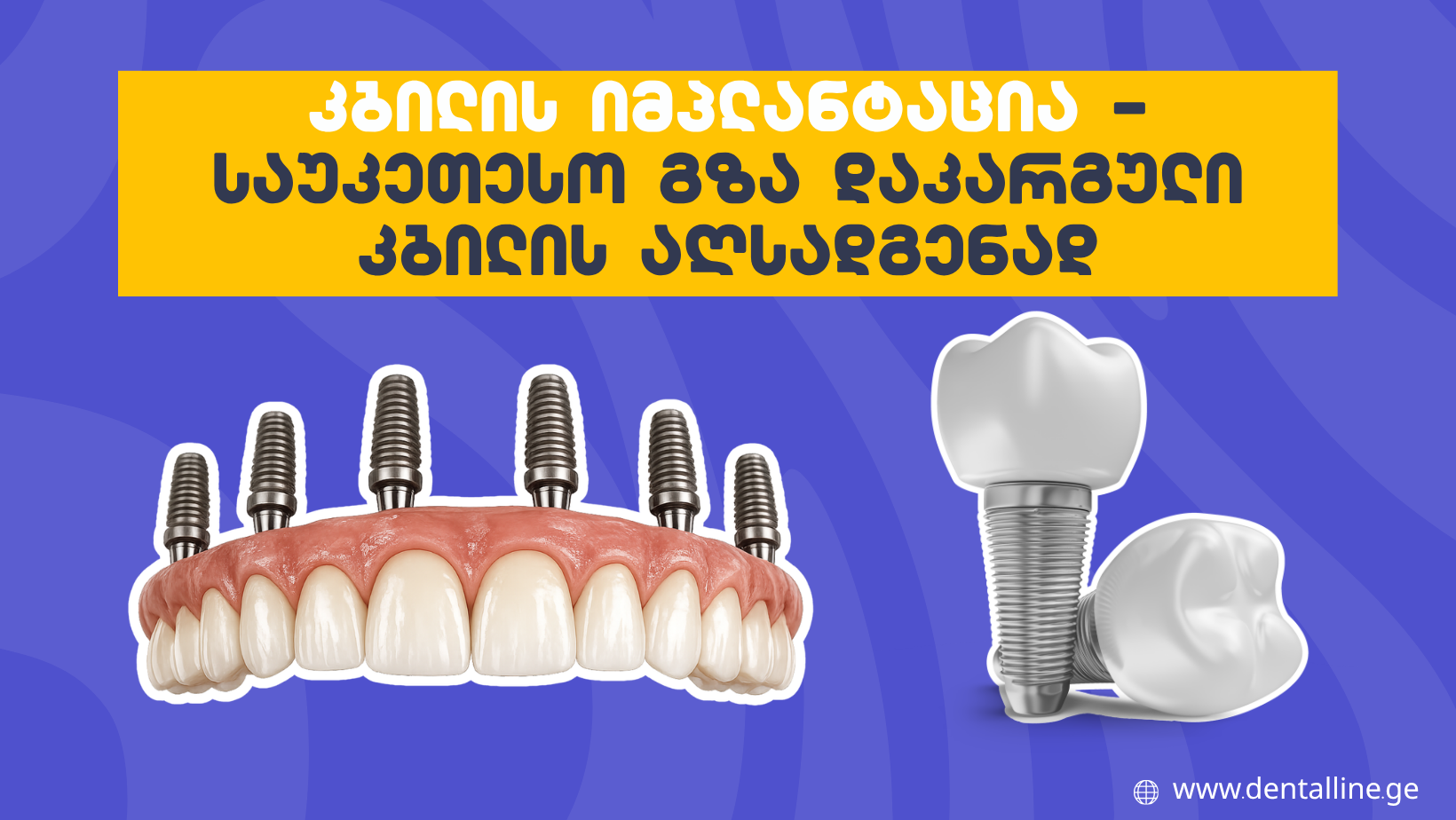 კბილის იმპლანტაცია – საუკეთესო გზა დაკარგული კბილის აღსადგენად