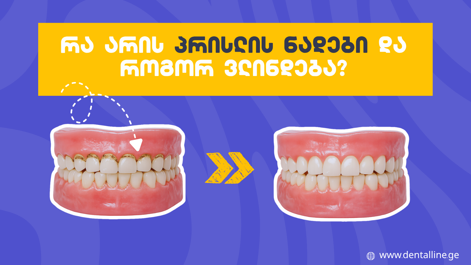 რა არის პრისლის ნადები და როგორ ვლინდება?